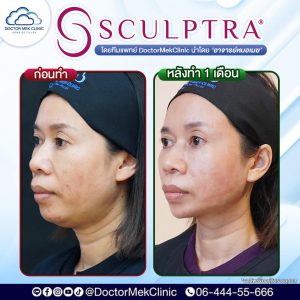 before after Sculptra