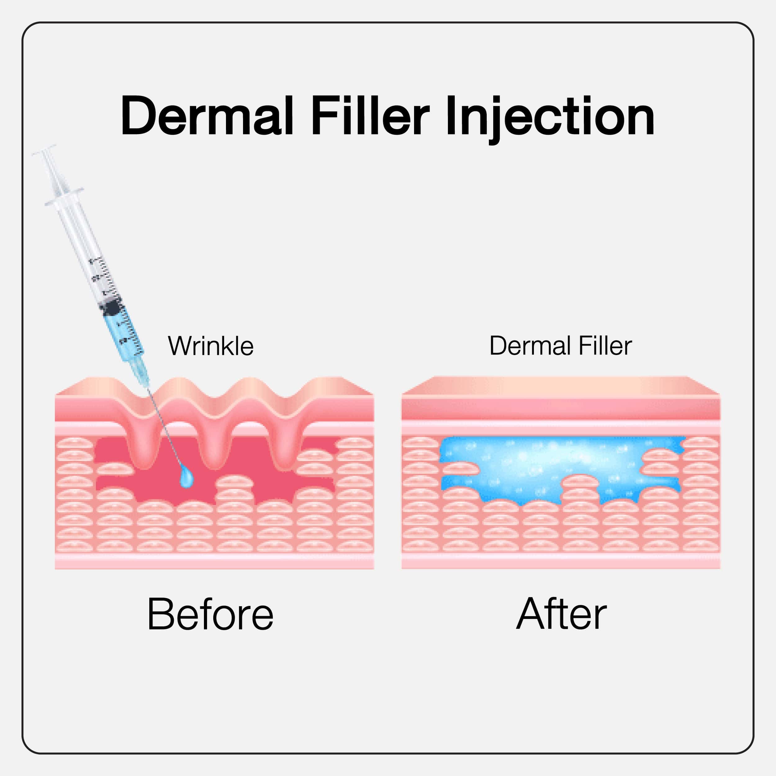 Dermal Filler Injection ฟิลเลอร์คืออะไร