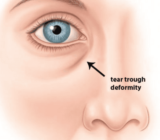 ร่องน้ำตา (Tear Trough Deformity)