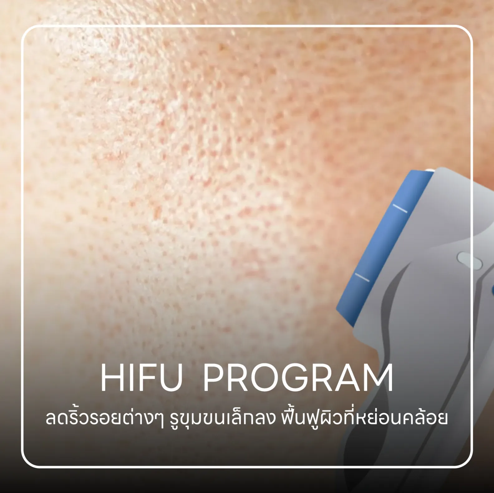 HIFU Program