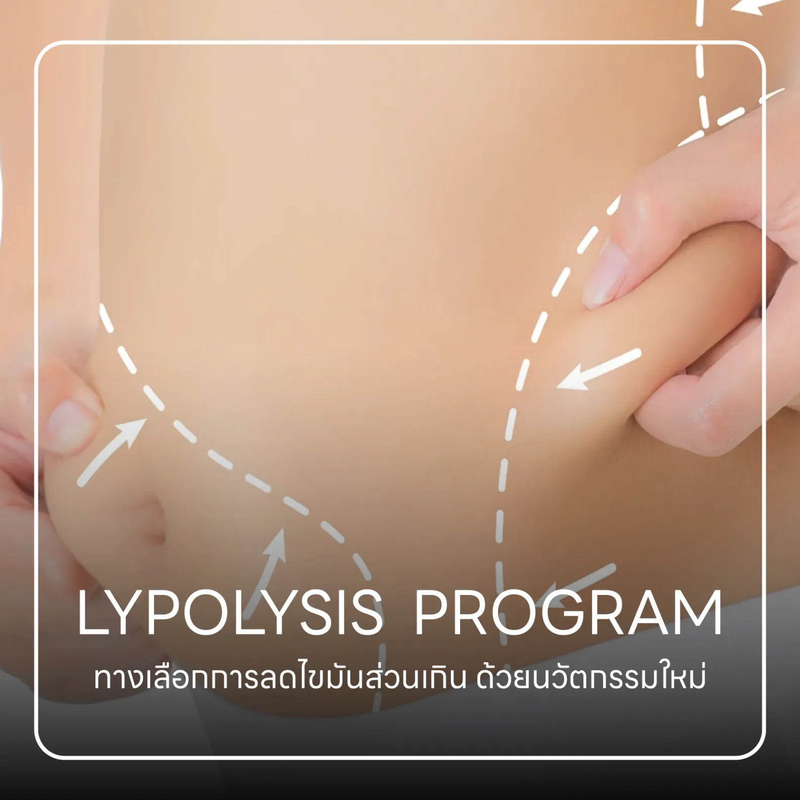 LYPOLYSIS Program