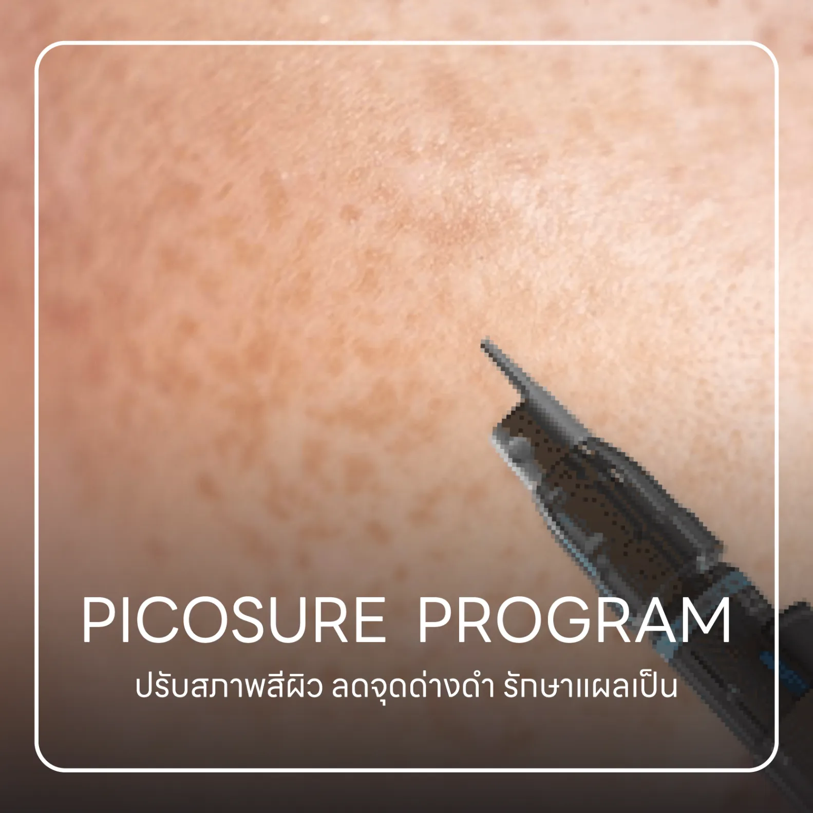 PICOSURE Program