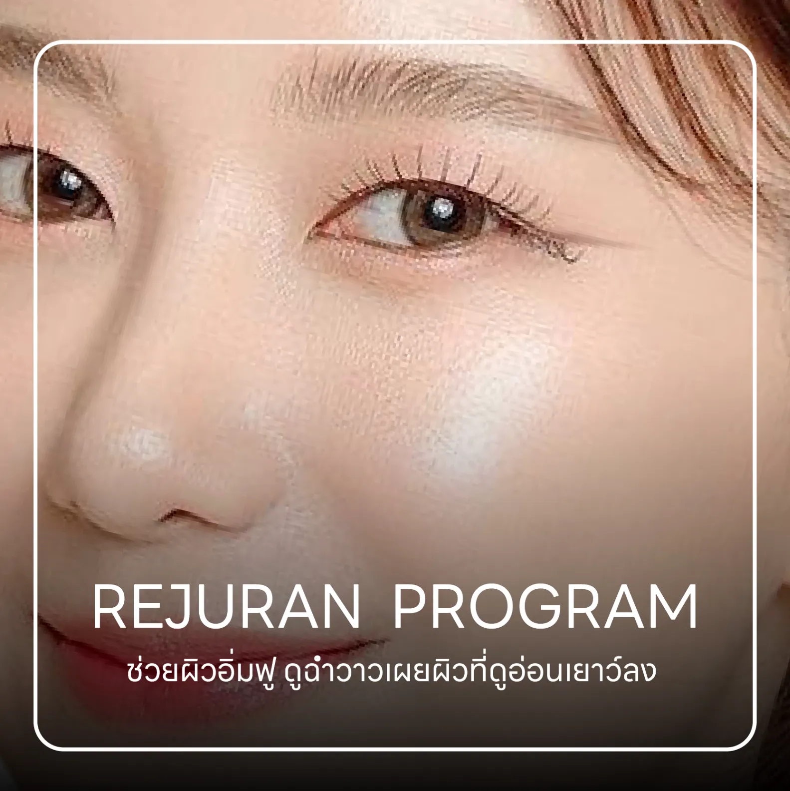 REJURAN Program